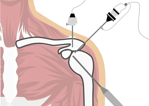 artroscopia de hombro