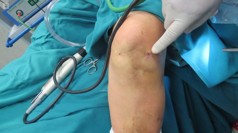 artroscopia de rodilla