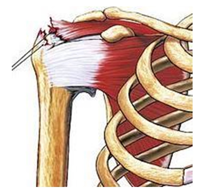 tratamiento maguito rotador