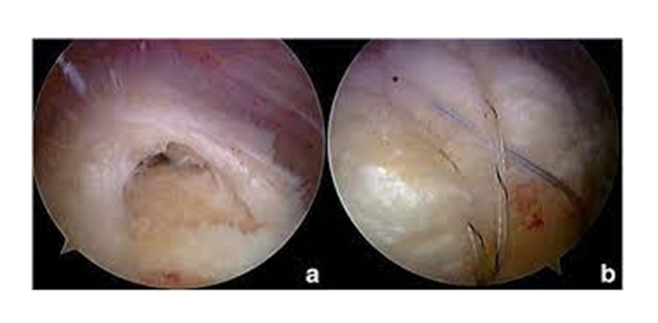 tratamiento maguito rotador